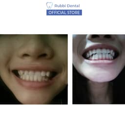 Niềng răng trong suốt tại nhà chính hãng Trainer - Bộ chỉnh nha dành cho trẻ em A1 + A2 + A3 6