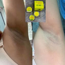 [Combo 3 hộp * 10G] kem Cô Bơ triệt thâm nách hôi nách CỰC KÌ hiệu quả chỉ sau 1 liệu trình 1