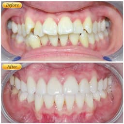 Niềng răng trong suốt niềng răng tại nhà chính hãng TRAINER - Bộ chỉnh nha dành cho người lớn và trẻ em A1 + A2 + A3 5