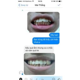 Niềng răng trong suốt niềng răng tại nhà chính hãng TRAINER - Bộ chỉnh nha dành cho người lớn và trẻ em A1 + A2 + A3 7