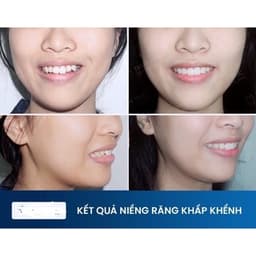Niềng răng trong suốt niềng răng tại nhà chính hãng TRAINER - Bộ chỉnh nha dành cho người lớn và trẻ em A1 + A2 + A3 3