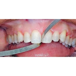 Niềng răng trong suốt niềng răng tại nhà chính hãng TRAINER - Bộ chỉnh nha dành cho người lớn và trẻ em A1 + A2 + A3 5