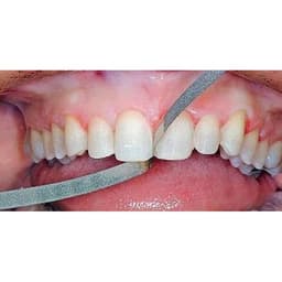 Niềng răng trong suốt niềng răng tại nhà chính hãng TRAINER - Bộ chỉnh nha dành cho người lớn và trẻ em A1 + A2 + A3 8