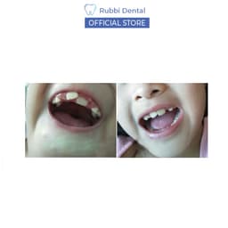Niềng răng trong suốt tại nhà chính hãng Trainer - Bộ chỉnh nha dành cho trẻ em A1 + A2 + A3 5