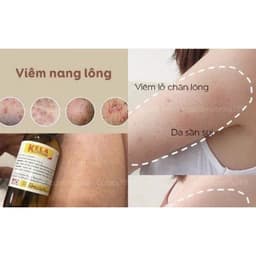 Kela Lotion Thái Lan Dùng Cho Da Viêm Lỗ Chân Lông Giúp Da Mịn Màng 30ml/60ml 3