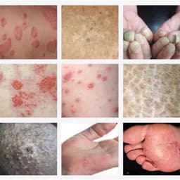 Combo 10 Tuýp Kem vua bọ cạp bôi nấm ngứa, hắc lào, á sừng, nấm da đầu, vảy nến [ngocanhngocanh98] 4