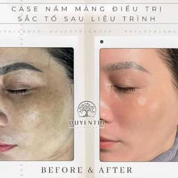 023 Duyên Thị - Serum Tái Tạo Toàn Diện Chuyên Mụn, Nám, Tàn Nhang - Mẫu Mới Của Bách Y Sâm 02 Plus 9