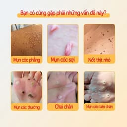 (Chính Hãng) (Hỏa Tốc) Kem bôi loại bỏ mụn thịt, mụn nhỏ ở cổ, mụn cóc ,Tuýp 20g 5