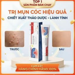 (Chính Hãng) (Hỏa Tốc) Kem bôi loại bỏ mụn thịt, mụn nhỏ ở cổ, mụn cóc, nách – Dưỡng da làm đẹp. 6