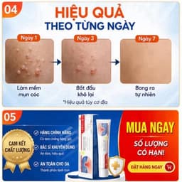 (Chính Hãng) (Hỏa Tốc) Kem bôi loại bỏ mụn thịt, mụn nhỏ ở cổ, mụn cóc, nách – Dưỡng da làm đẹp. 9