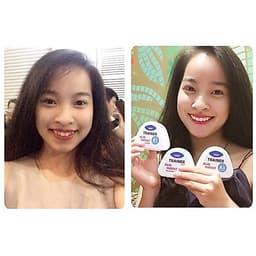 Niềng răng trong suốt niềng răng tại nhà chính hãng TRAINER - Bộ chỉnh nha dành cho người lớn và trẻ em A1 + A2 + A3 9