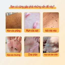(Chính Hãng) (Hỏa Tốc) Kem bôi loại bỏ mụn thịt, mụn nhỏ ở cổ, mụn cóc, nách – Dưỡng da làm đẹp. 3