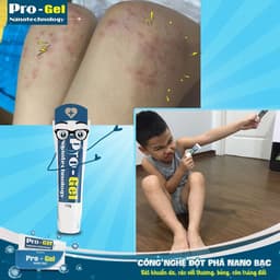Kem Hăm Da, Bỏng, Tay Chân Miệng, Côn Trùng Đốt, Mụn Nhọt, Vết Thương Hở, An Toàn Cho Trẻ Sơ Sinh - Pro Gel Nano Bạc 5
