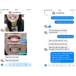 Niềng răng trong suốt niềng răng tại nhà chính hãng TRAINER - Bộ chỉnh nha dành cho người lớn và trẻ em A1 + A2 + A3 7