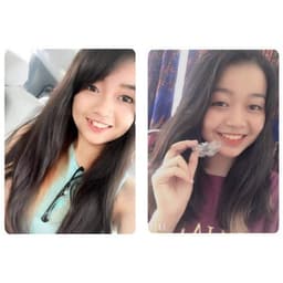 Niềng răng trong suốt niềng răng tại nhà chính hãng TRAINER - Bộ chỉnh nha dành cho người lớn và trẻ em A1 + A2 + A3 6