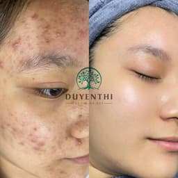 023 Duyên Thị - Serum Tái Tạo Toàn Diện Chuyên Mụn, Nám, Tàn Nhang - Mẫu Mới Của Bách Y Sâm 02 Plus 8