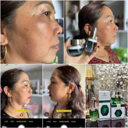 Kem nám và serum nám Huyền Phi giúp xóa các vết nám tàn nhang làm trắng sáng da 7