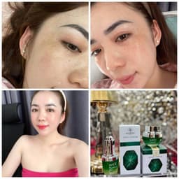 Kem nám và serum nám Huyền Phi giúp xóa các vết nám tàn nhang làm trắng sáng da 5