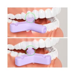 Miếng cắn chữ Y cho khay niềng răng trong suốt 3