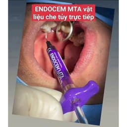 Endocem MTA nha khoa  trám bít ống tủy 2