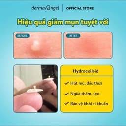 Miếng Dán Mụn Derma Angel Acne Patch 12 Miếng 4
