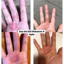 Kem Nobason 30gr Hàn Quốc Thoa Da Khô, Á Sừng, Chàm Nứt Nẻ Chân Tay 4