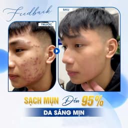 Klena BPO Adapalene 0.1% Benzoyl Peroxide 2.5% 30g Hỗ Trợ Giảm Mụn, Mờ Thâm Sau Mụn 8