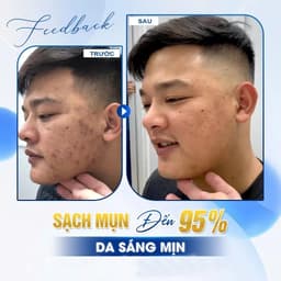 Klena BPO Adapalene 0.1% Benzoyl Peroxide 2.5% 30g Hỗ Trợ Giảm Mụn, Mờ Thâm Sau Mụn 7