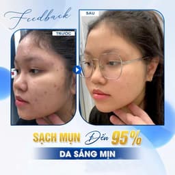 Klena BPO Adapalene 0.1% Benzoyl Peroxide 2.5% 30g Hỗ Trợ Giảm Mụn, Mờ Thâm Sau Mụn 6