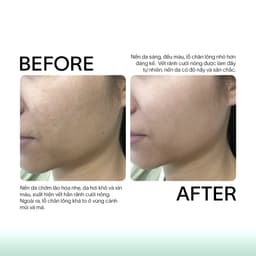 Tế bào gốc hỗ trợ xóa sẹo, Phục Hồi Da Peel, Da sau laser GSC GA Anti Ageing Ampoule X 10ml 6