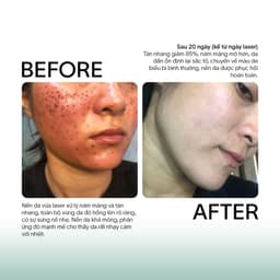 Tế bào gốc hỗ trợ xóa sẹo, Phục Hồi Da Peel, Da sau laser GSC GA Anti Ageing Ampoule X 10ml 8