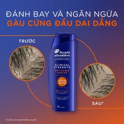 Dầu Gội Trị Gàu Head & Shoulders MOLLYHAIR Chuyên Sâu Giảm Ngứa & Sạch Gàu Cứng Đầu, Giúp Tự Tin Sau Mỗi Lần Dùng 400ml 2