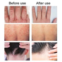 Kem bôi nấm ngứa ngoài da nội địa trung(bọ cạp đen) 3