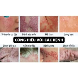 Kem bôi nấm ngứa ngoài da nội địa trung(bọ cạp đen) 2