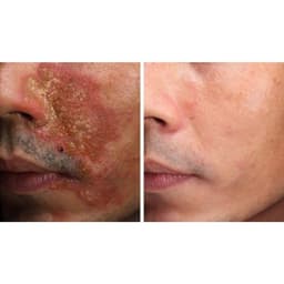 Kem bôi nấm ngứa ngoài da nội địa trung(bọ cạp đen) 4